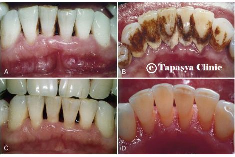 Bad Breath, Bleeding Gums - Tapasya